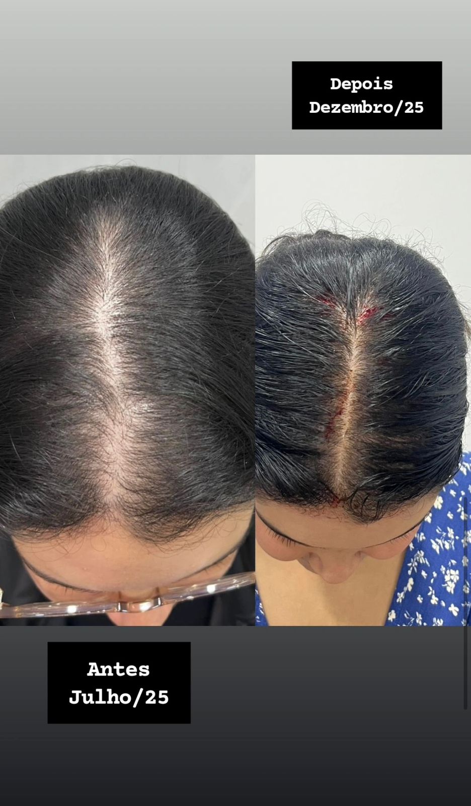 Antes e depois de tratamento para alopecia androgenética feminina