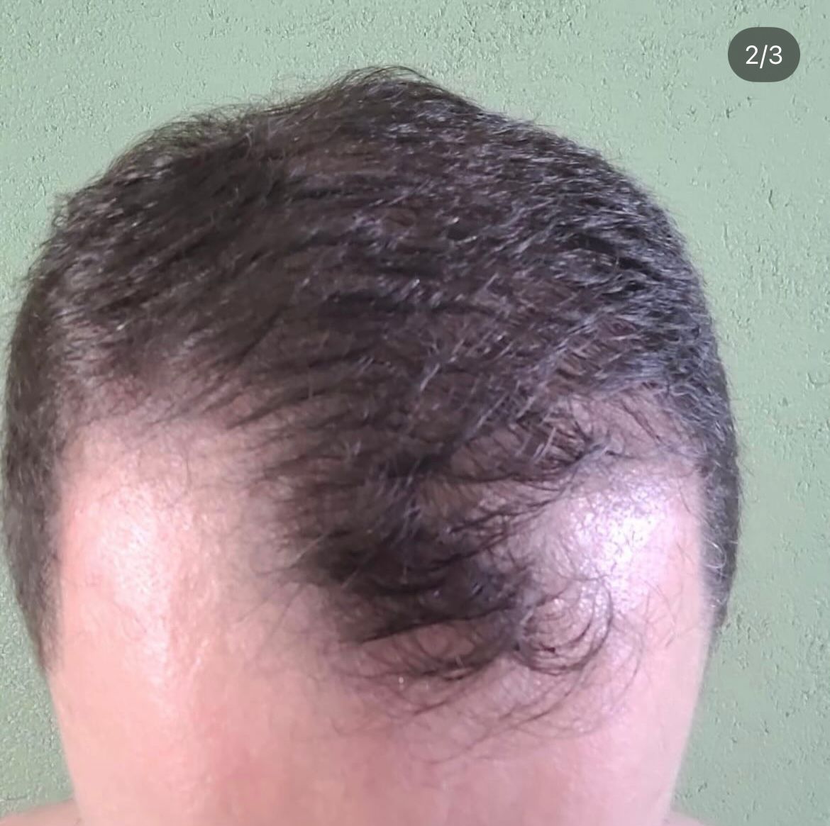 Antes e depois de recuperação de densidade capilar