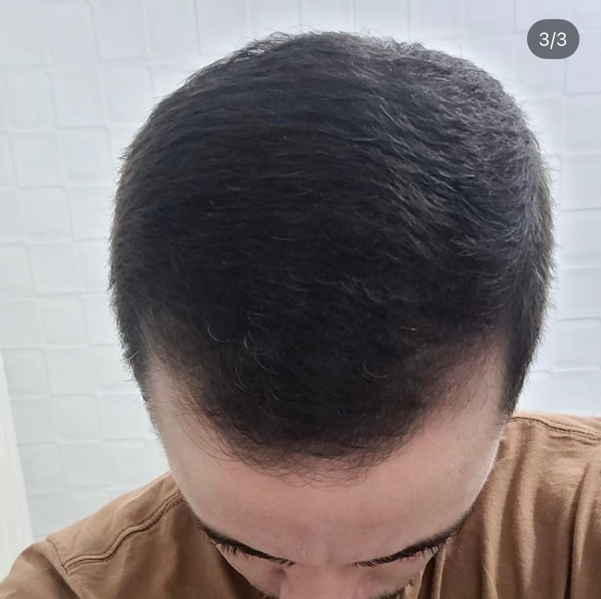 Antes e depois de reconstrução da linha frontal